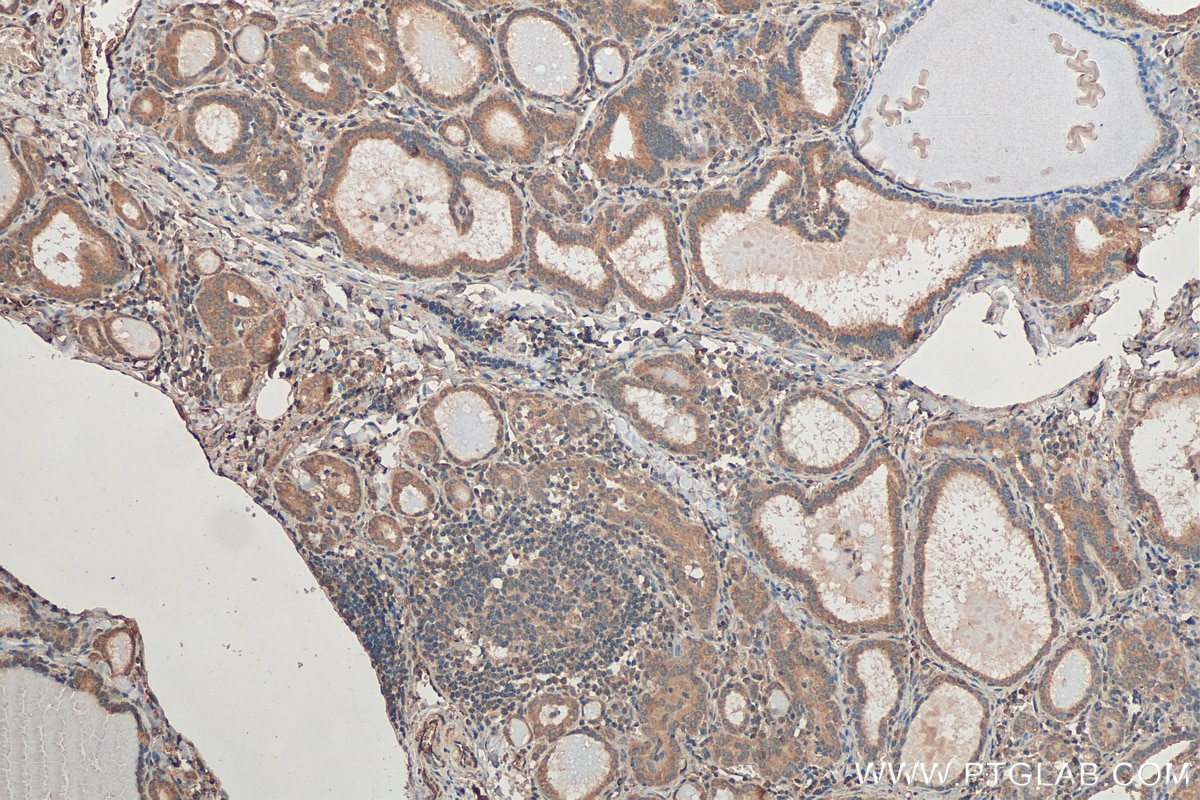 Immunohistochemistry (IHC) staining of human thyroid cancer tissue using ZDHHC12 Polyclonal antibody (26433-1-AP)