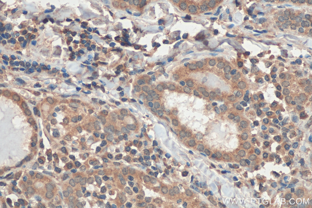 Immunohistochemistry (IHC) staining of human thyroid cancer tissue using ZDHHC12 Polyclonal antibody (26433-1-AP)