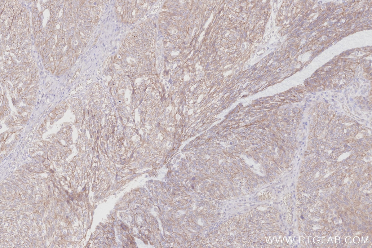Immunohistochemistry (IHC) staining of human ovary cancer tissue using ZDHHC5 Recombinant antibody (84803-4-RR)