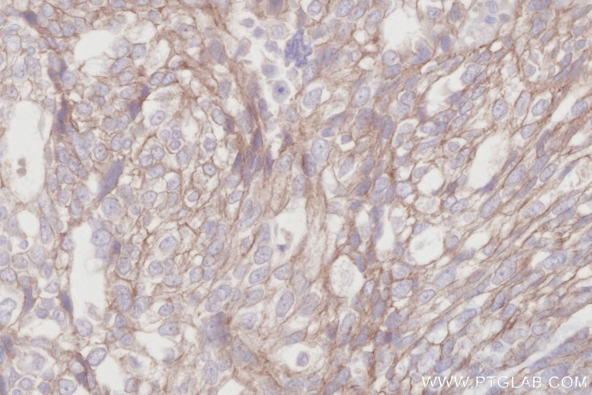 Immunohistochemistry (IHC) staining of human ovary cancer tissue using ZDHHC5 Recombinant antibody (84803-4-RR)