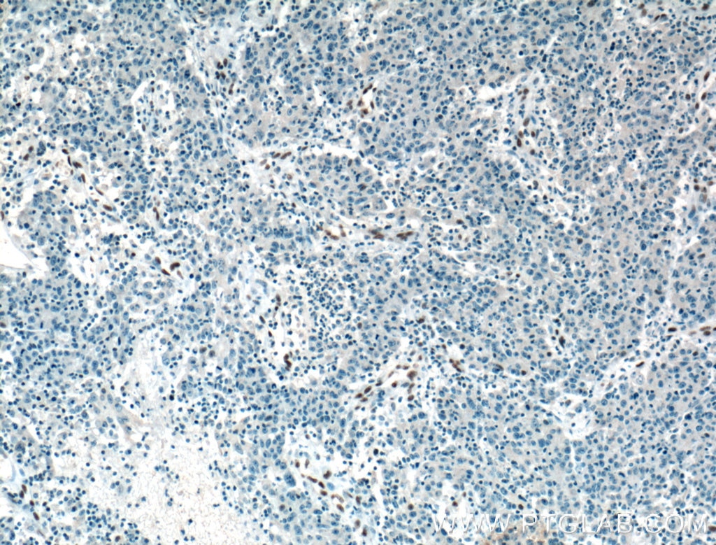 Immunohistochemistry (IHC) staining of human colon cancer tissue using ZEB1 Monoclonal antibody (66279-1-Ig)
