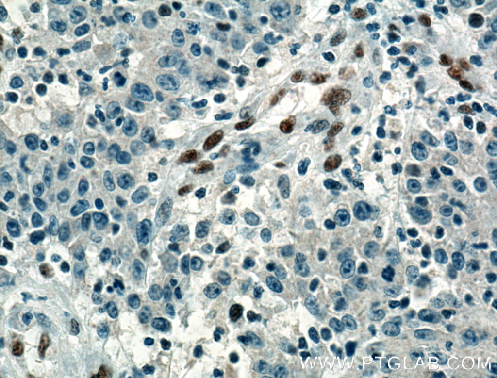 Immunohistochemistry (IHC) staining of human colon cancer tissue using ZEB1 Monoclonal antibody (66279-1-Ig)