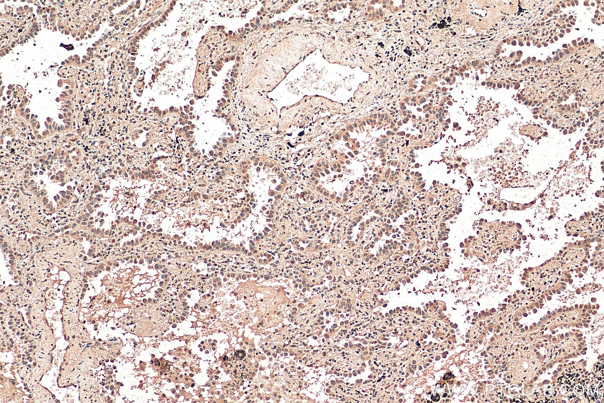 Immunohistochemistry (IHC) staining of human lung cancer tissue using ZEB1 Monoclonal antibody (66279-1-Ig)