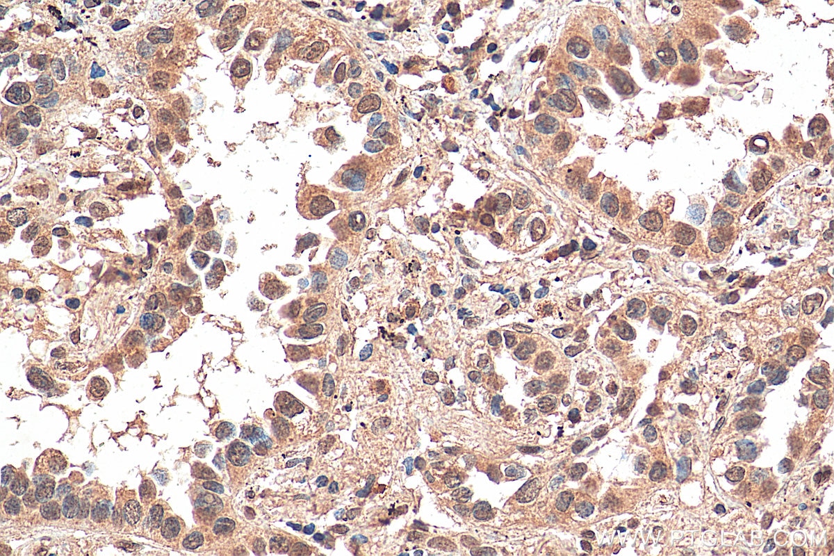 Immunohistochemistry (IHC) staining of human lung cancer tissue using ZEB1 Monoclonal antibody (66279-1-Ig)