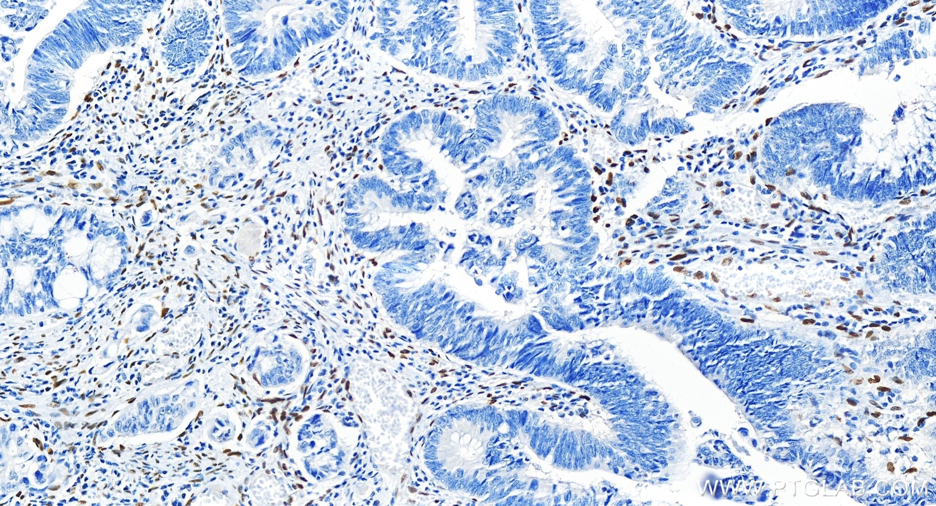 Immunohistochemistry (IHC) staining of human colon cancer tissue using ZEB1 Recombinant antibody (85729-1-RR)