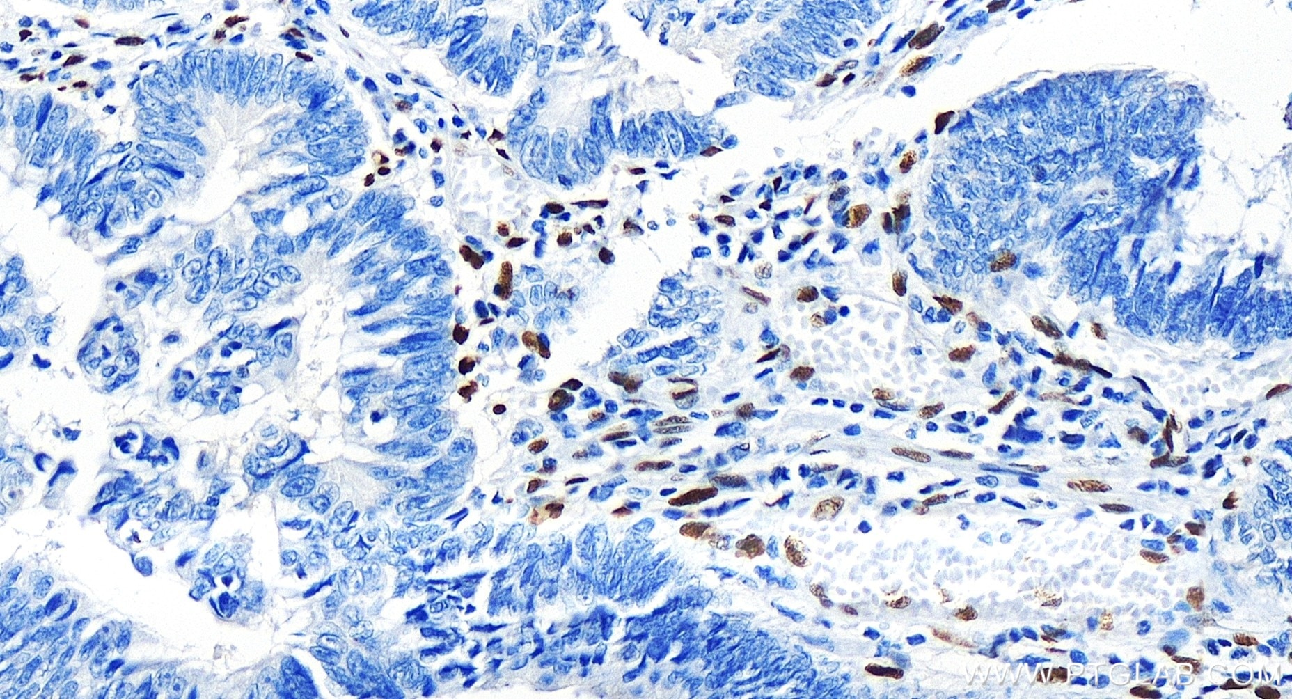 Immunohistochemistry (IHC) staining of human colon cancer tissue using ZEB1 Recombinant antibody (85729-1-RR)