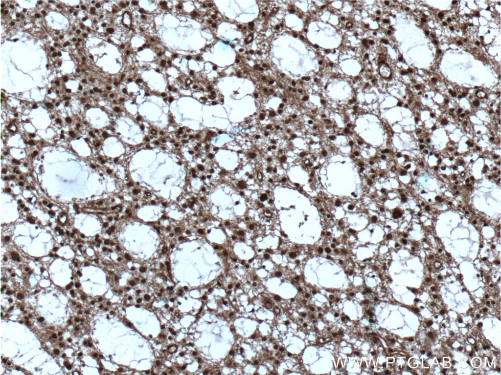 Immunohistochemistry (IHC) staining of human gliomas tissue using ZEB2 Polyclonal antibody (14026-1-AP)