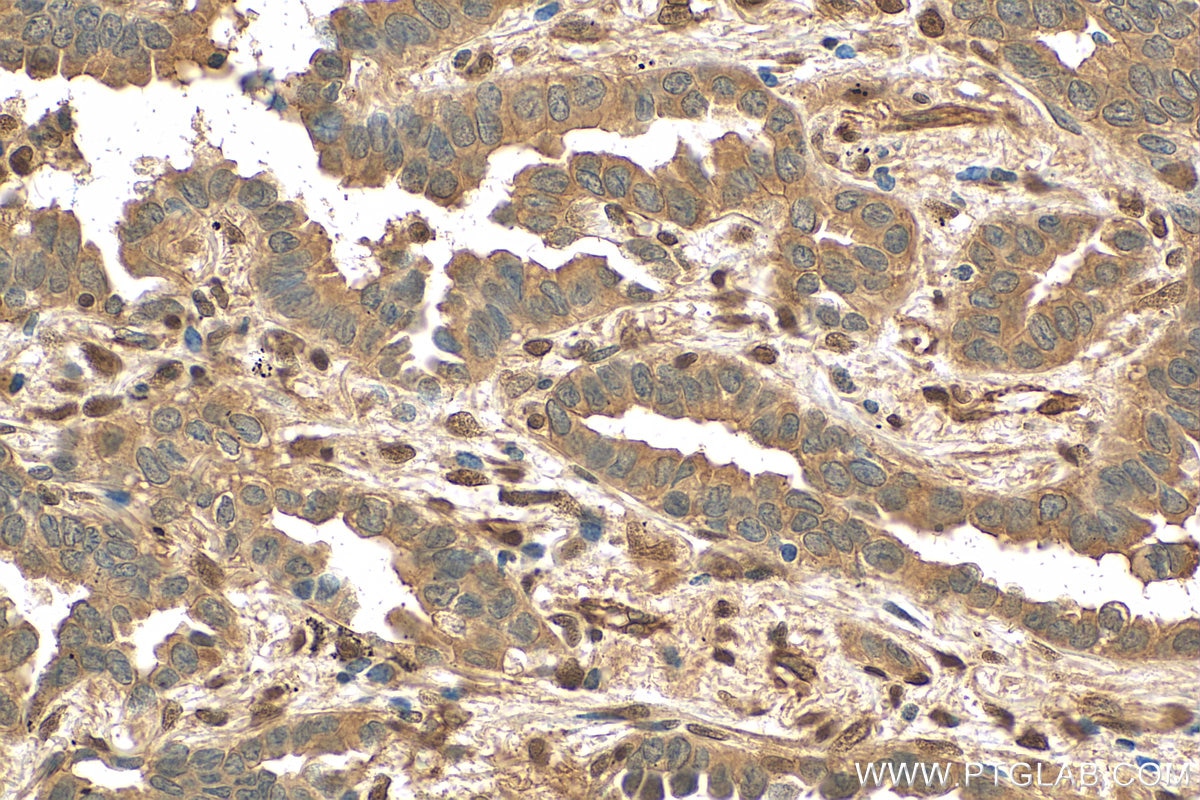 Immunohistochemistry (IHC) staining of human lung cancer tissue using ZEB2 Polyclonal antibody (14026-1-AP)