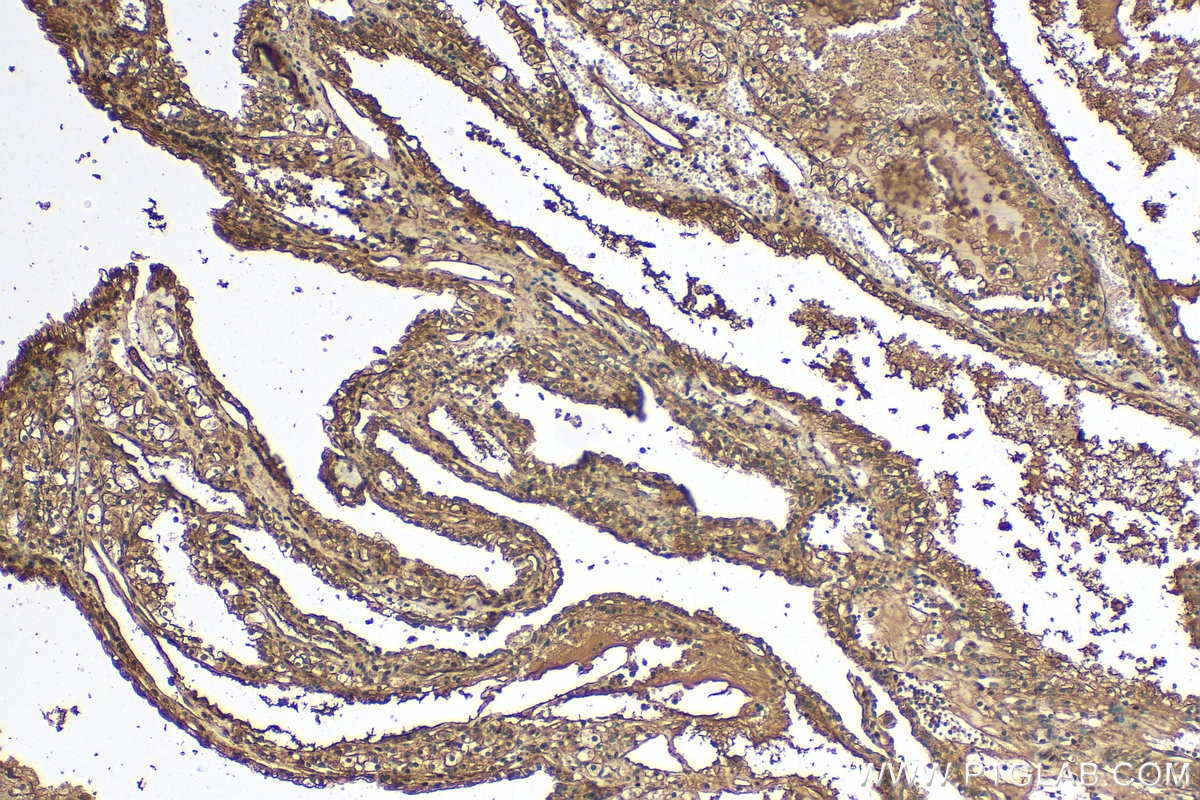 IHC staining of human renal cell carcinoma using 14026-1-AP