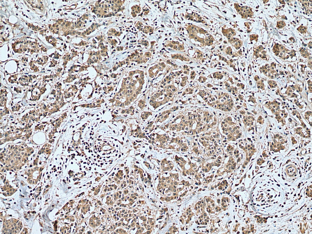 Immunohistochemistry (IHC) staining of human breast cancer tissue using ZEB2 Monoclonal antibody (67514-1-Ig)