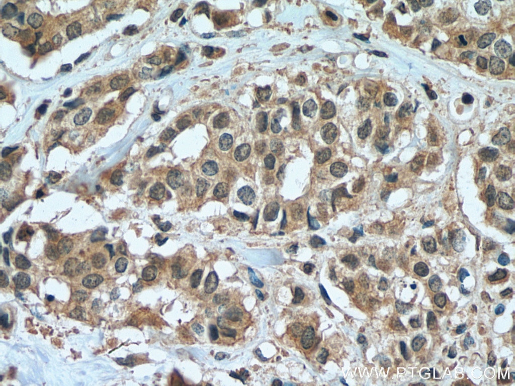 Immunohistochemistry (IHC) staining of human breast cancer tissue using ZEB2 Monoclonal antibody (67514-1-Ig)