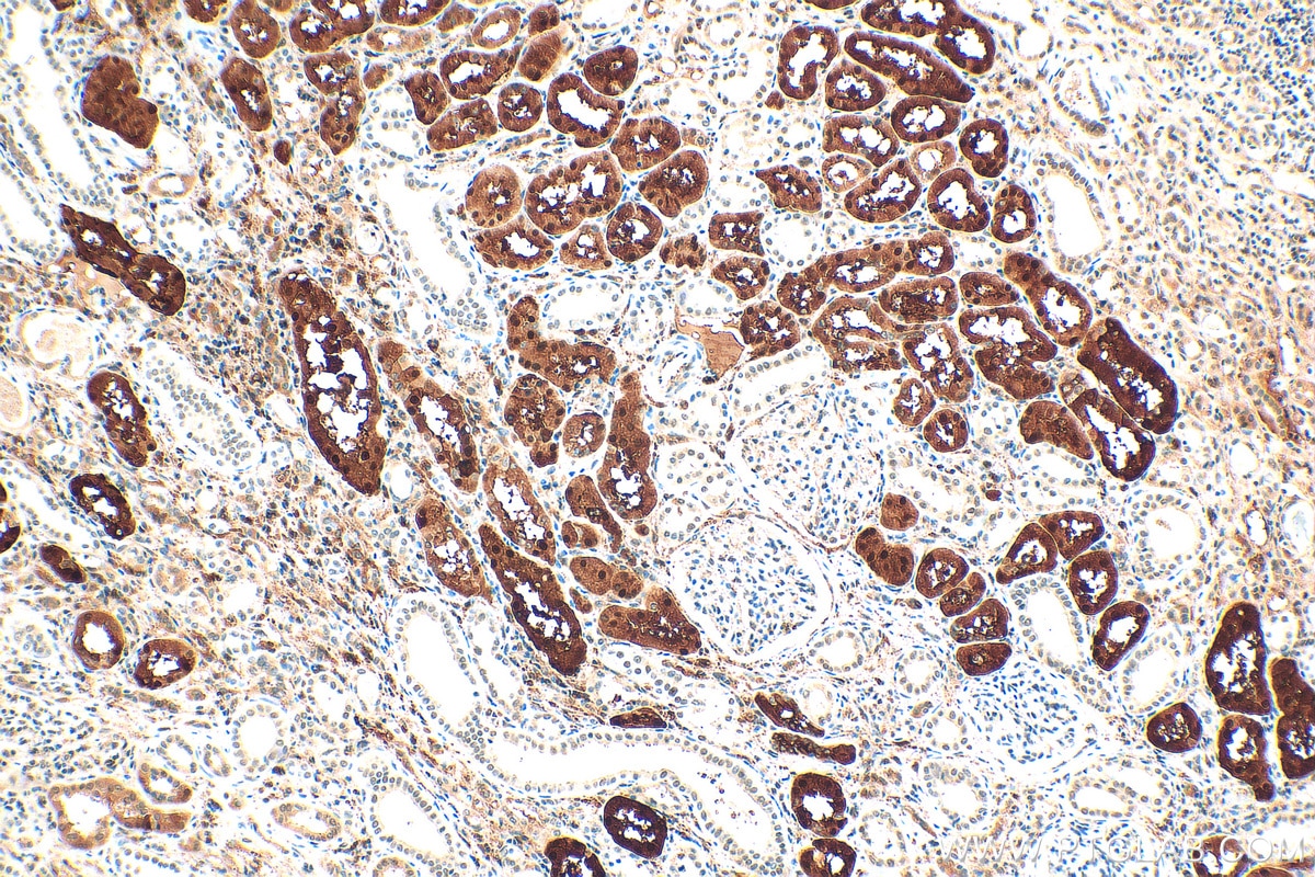 Immunohistochemistry (IHC) staining of human renal cell carcinoma tissue using ZEB2 Recombinant antibody (82020-1-RR)