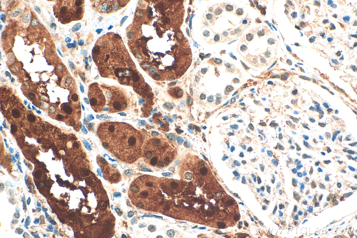 Immunohistochemistry (IHC) staining of human renal cell carcinoma tissue using ZEB2 Recombinant antibody (82020-1-RR)