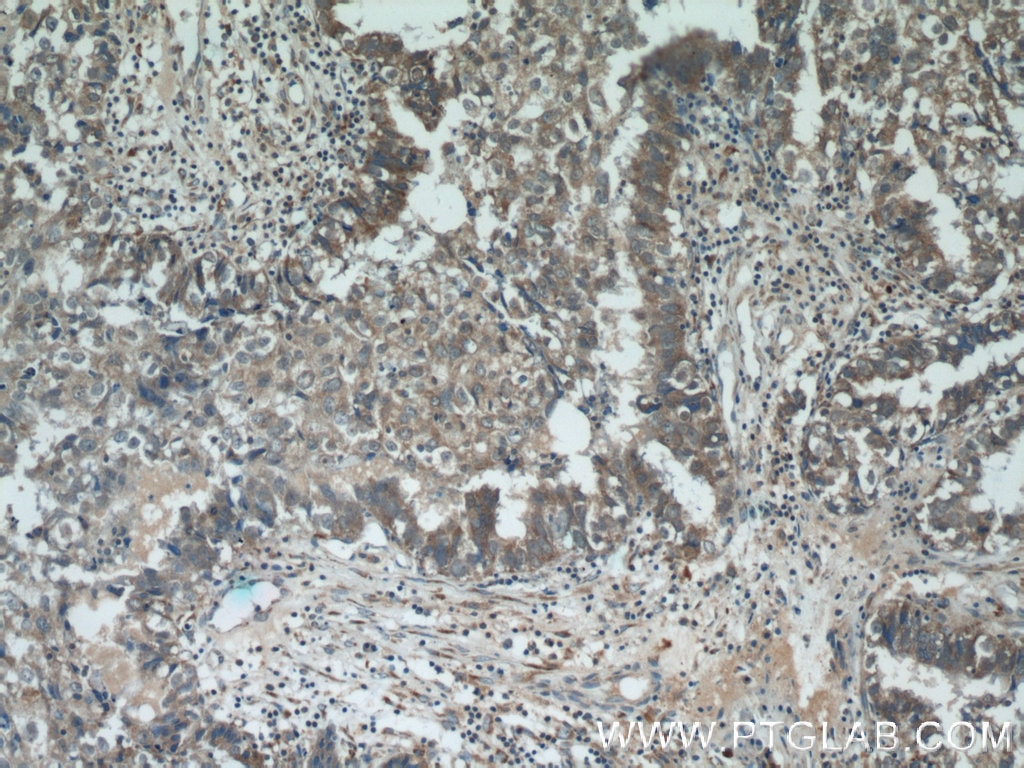 Immunohistochemistry (IHC) staining of human breast cancer tissue using ZFP36 Polyclonal antibody (12737-1-AP)