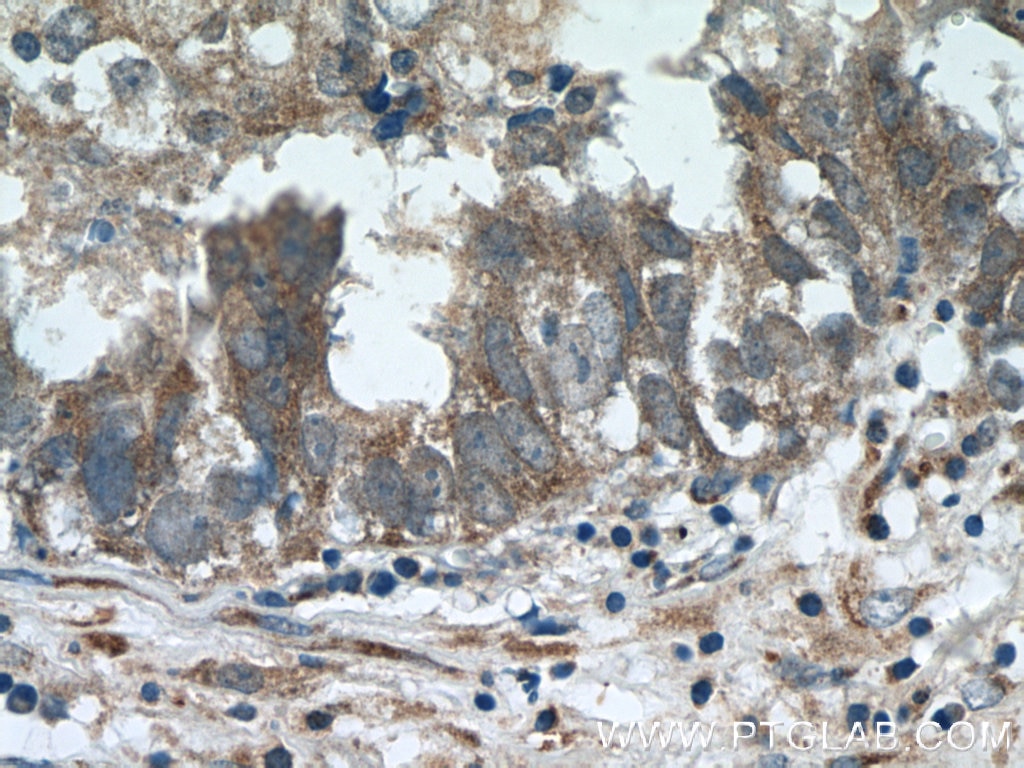 Immunohistochemistry (IHC) staining of human breast cancer tissue using ZFP36 Polyclonal antibody (12737-1-AP)