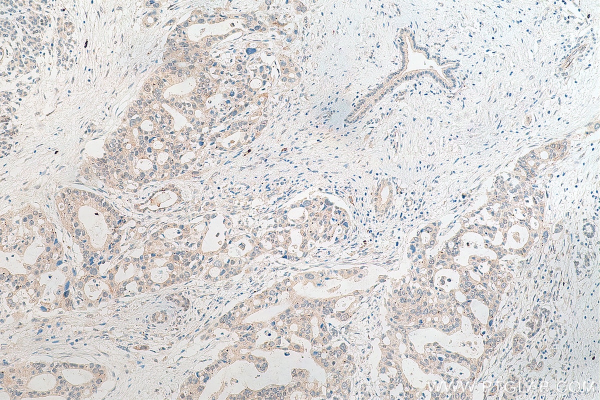 Immunohistochemistry (IHC) staining of human pancreas cancer tissue using ZFP36L2 Polyclonal antibody (19005-1-AP)