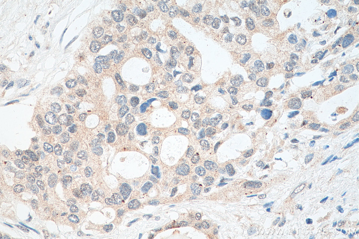 IHC staining of human pancreas cancer using 19005-1-AP