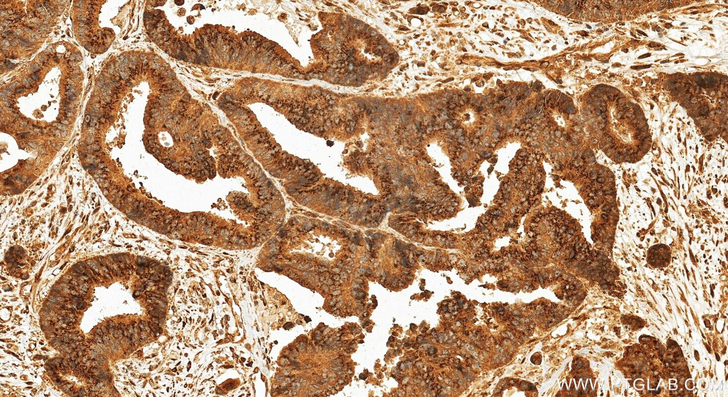 Immunohistochemical analysis of paraffin-embedded human colon cancer tissue slide using 27157-1-AP (ZFPL1 antibody) at dilution of 1:200 (under 20x lens). Heat mediated antigen retrieval with Tris-EDTA buffer (pH 9.0). Immunohistochemistry (IHC) staining of human colon cancer tissue using ZFPL1 Polyclonal antibody (27157-1-AP)