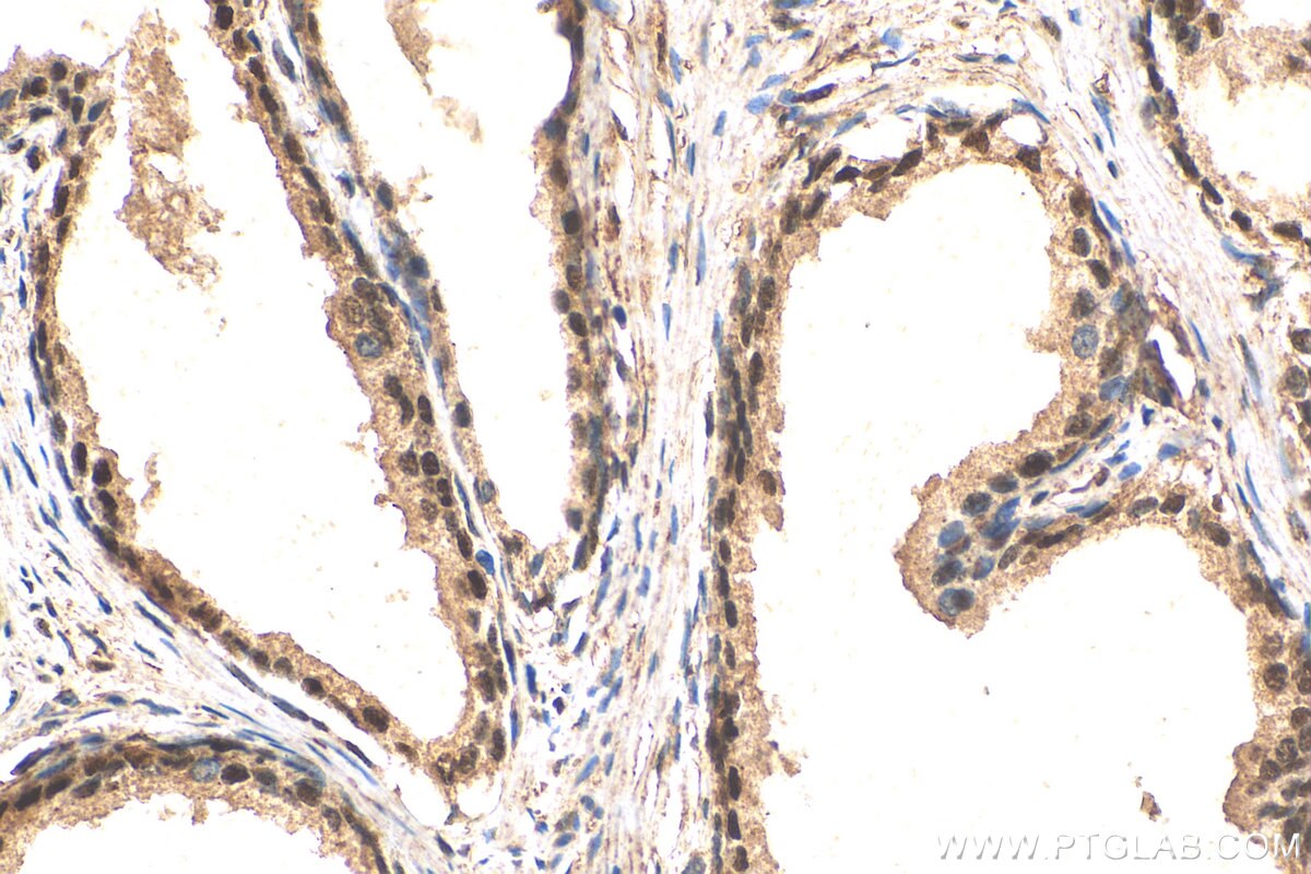 Immunohistochemistry (IHC) staining of human prostate cancer tissue using ZFPM1 Polyclonal antibody (28012-1-AP)