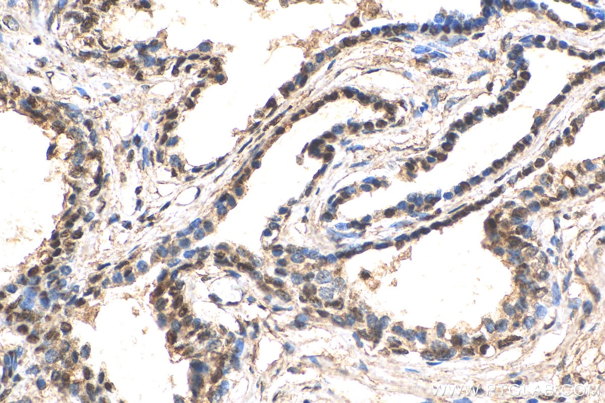 Immunohistochemistry (IHC) staining of human prostate cancer tissue using ZFPM1 Polyclonal antibody (28012-1-AP)