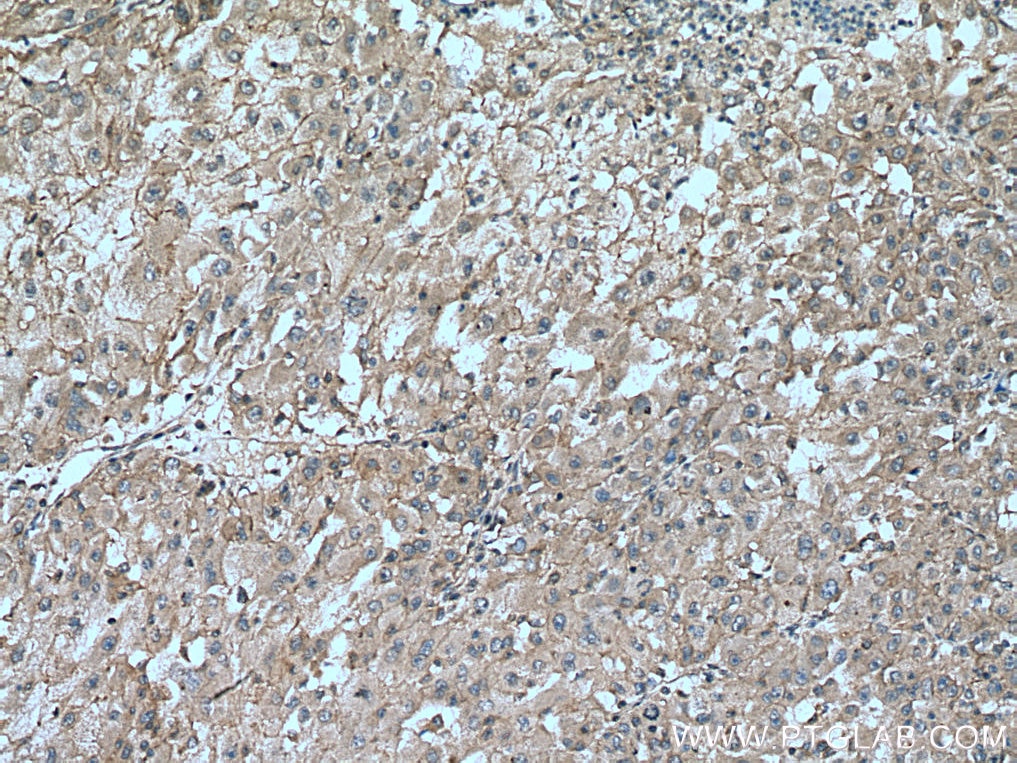 IHC staining of human liver cancer using 23163-1-AP