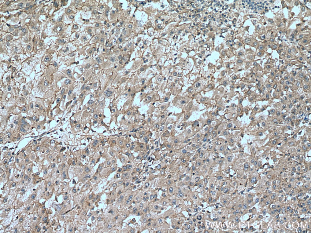 Immunohistochemistry (IHC) staining of human liver cancer tissue using ZFYVE19 Polyclonal antibody (23163-1-AP)