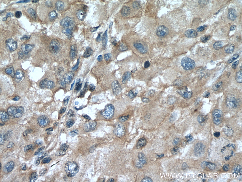 Immunohistochemistry (IHC) staining of human liver cancer tissue using ZFYVE19 Polyclonal antibody (23163-1-AP)