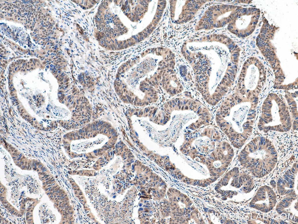Immunohistochemistry (IHC) staining of human colon cancer tissue using ZHX2 Polyclonal antibody (20136-1-AP)