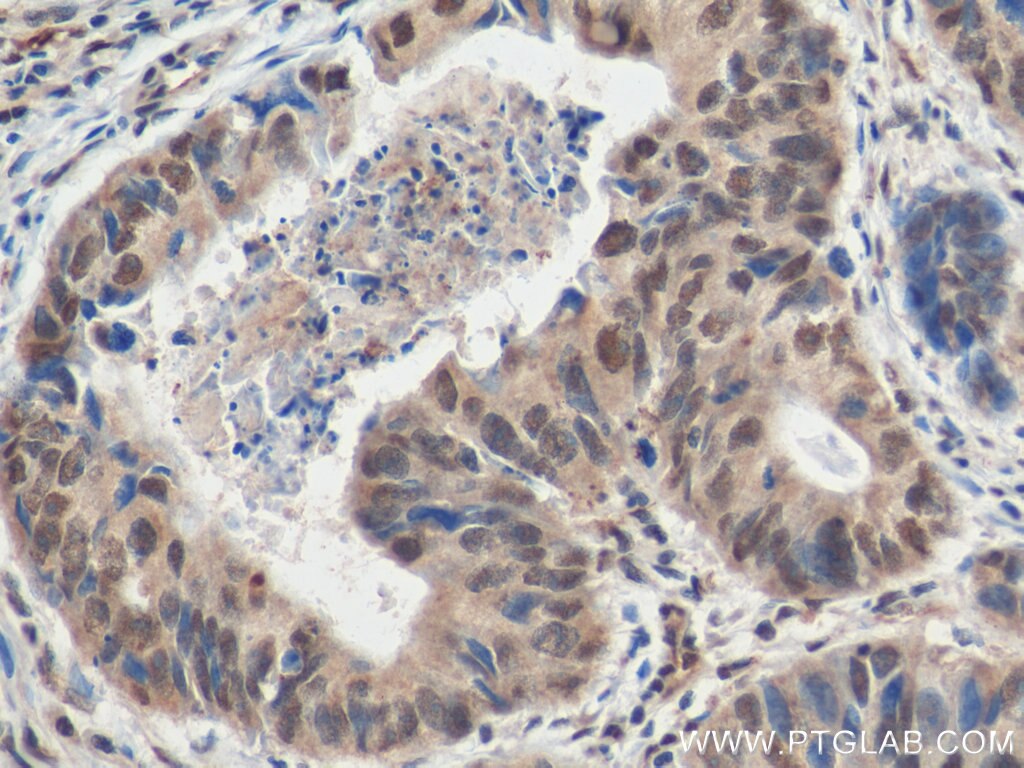 Immunohistochemistry (IHC) staining of human colon cancer tissue using ZHX2 Polyclonal antibody (20136-1-AP)