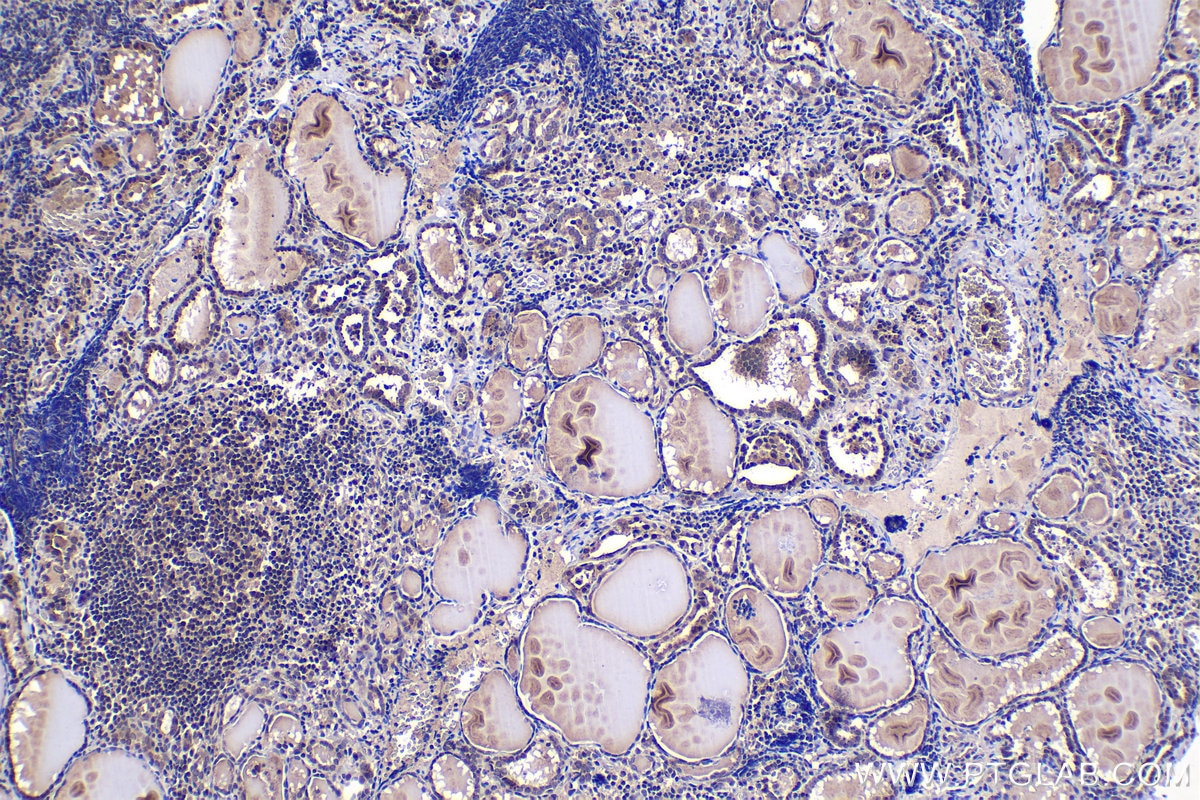 Immunohistochemistry (IHC) staining of human thyroid cancer tissue using ZIC3 Polyclonal antibody (21717-1-AP)
