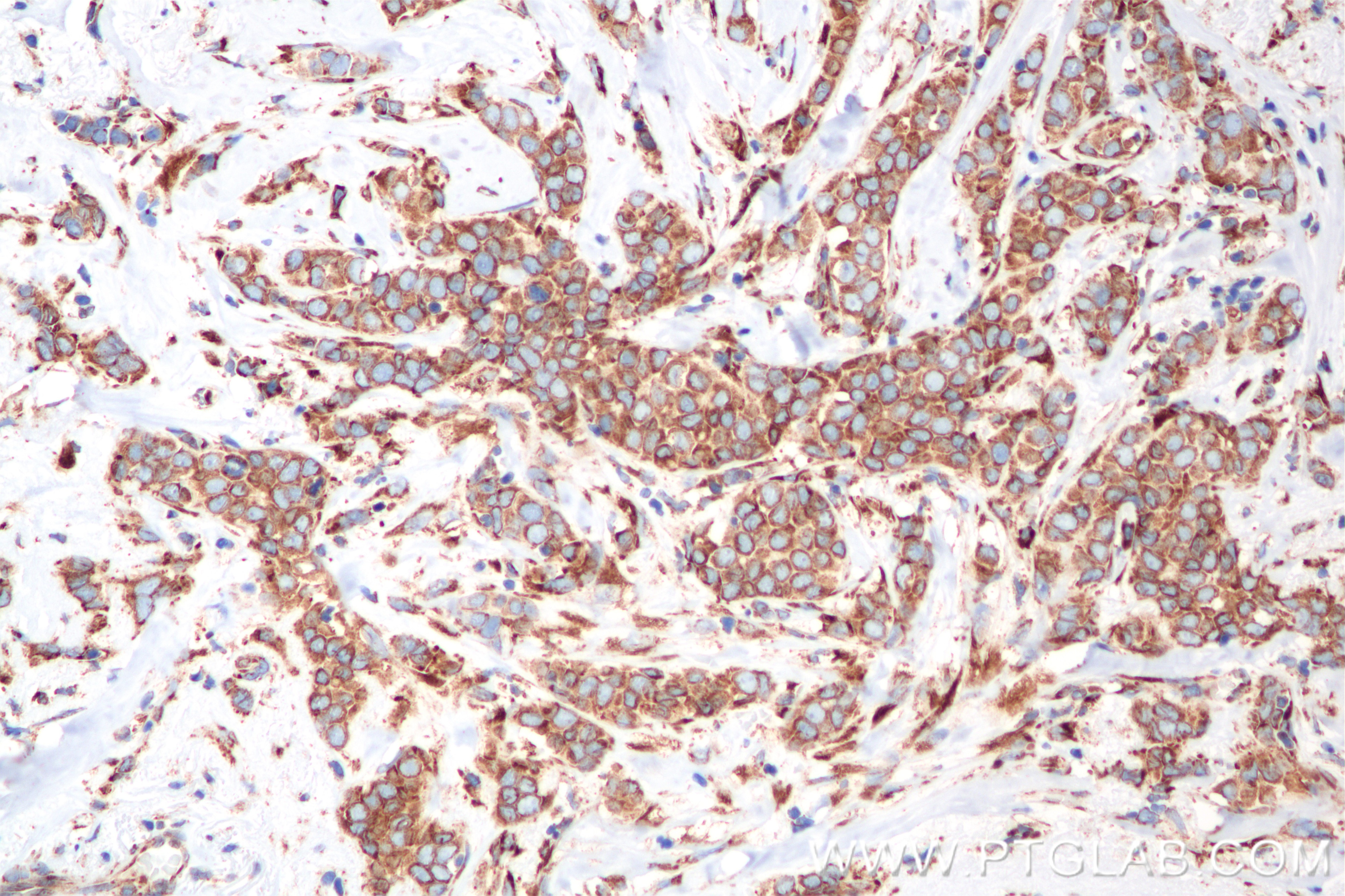 Immunohistochemistry (IHC) staining of human breast cancer tissue using ZIP7 Recombinant monoclonal antibody (85383-1-RR)