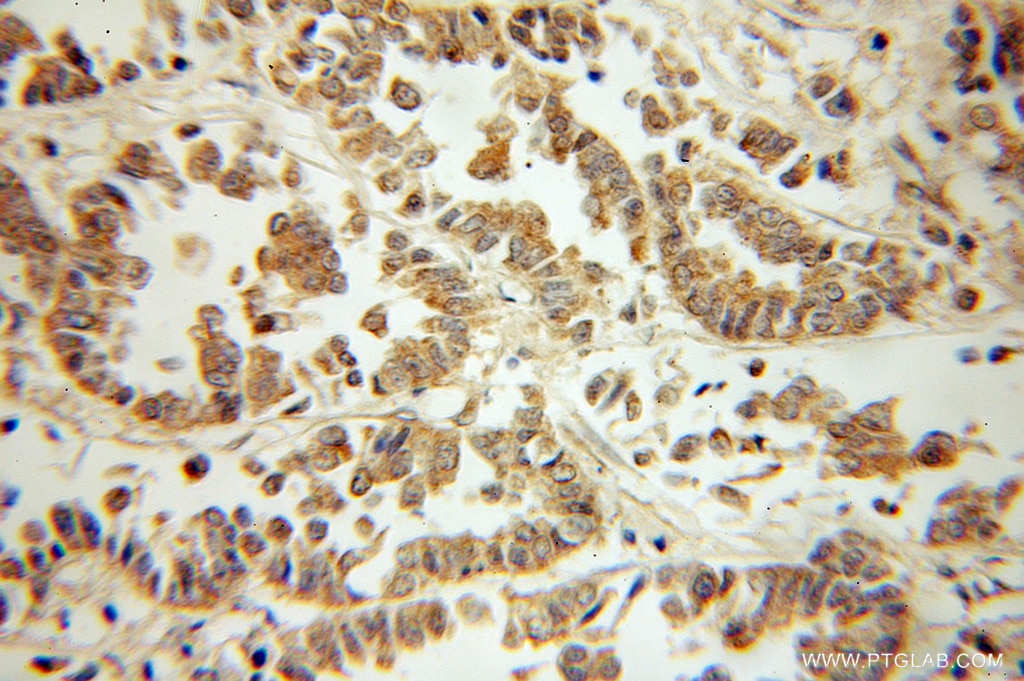 Immunohistochemistry (IHC) staining of human breast cancer tissue using Phospho-ZIPK (Ser311) Polyclonal antibody (51021-1-AP)
