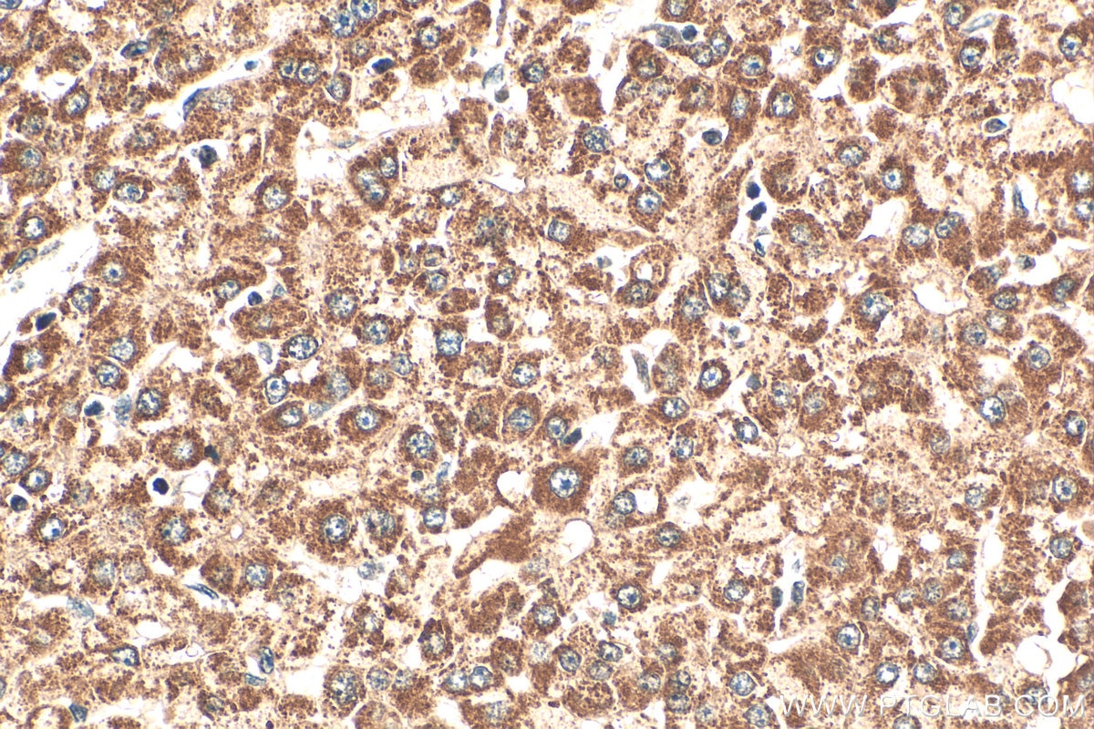 Immunohistochemistry (IHC) staining of human liver cancer tissue using ZMYND10 Polyclonal antibody (14431-1-AP)