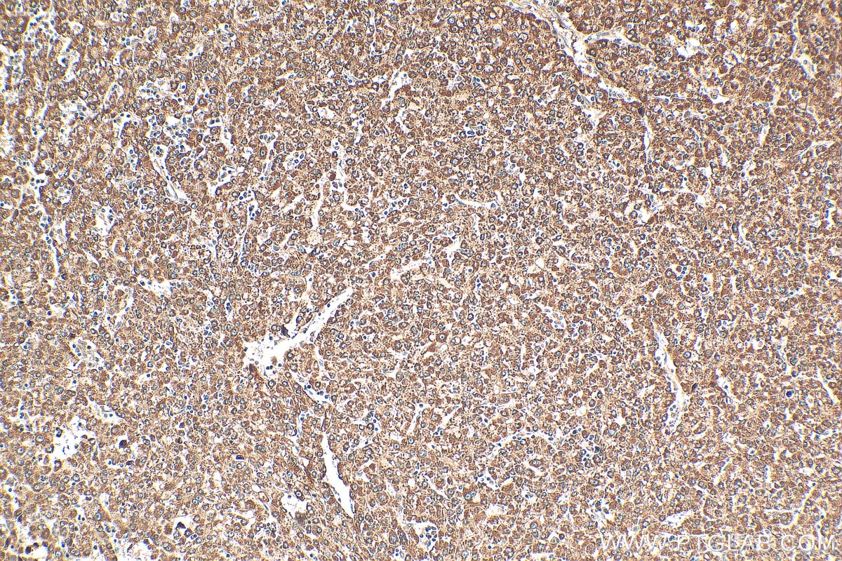Immunohistochemistry (IHC) staining of human liver cancer tissue using ZMYND10 Polyclonal antibody (14431-1-AP)