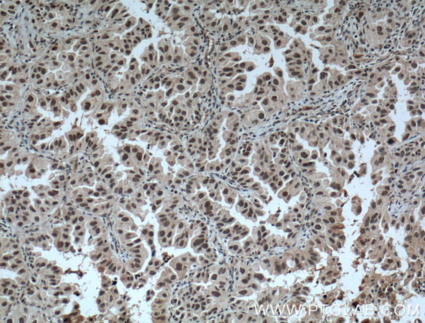 Immunohistochemistry (IHC) staining of human lung cancer tissue using ZMYND8 Polyclonal antibody (11633-1-AP)