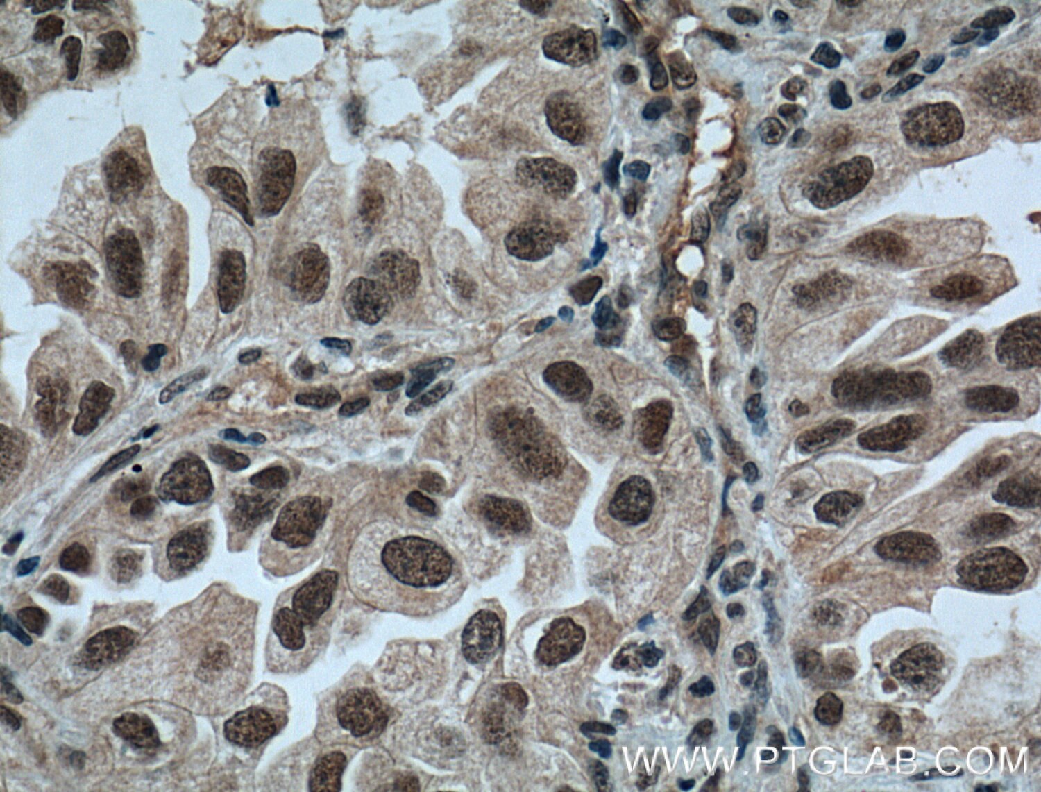 IHC staining of human lung cancer using 11633-1-AP