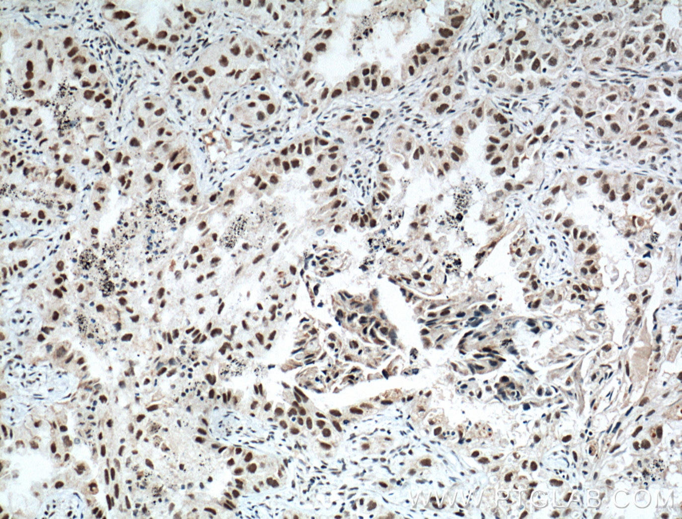 Immunohistochemistry (IHC) staining of human lung cancer tissue using ZMYND8 Polyclonal antibody (11633-1-AP)