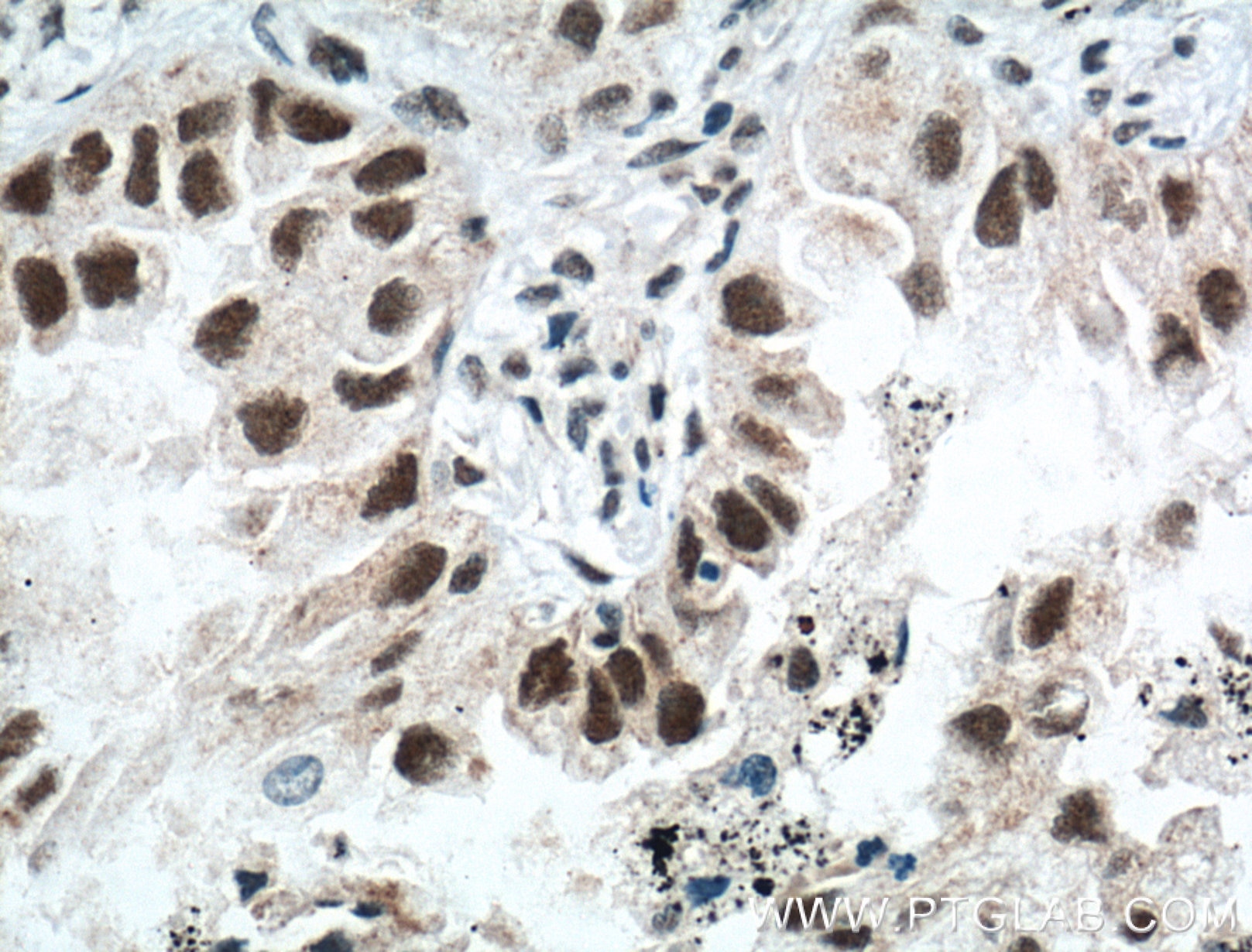 Immunohistochemistry (IHC) staining of human lung cancer tissue using ZMYND8 Polyclonal antibody (11633-1-AP)