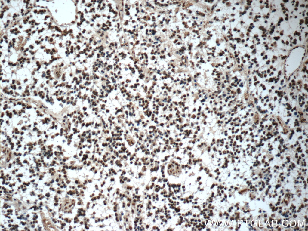 Immunohistochemistry (IHC) staining of human gliomas tissue using ZNF124 Polyclonal antibody (25216-1-AP)