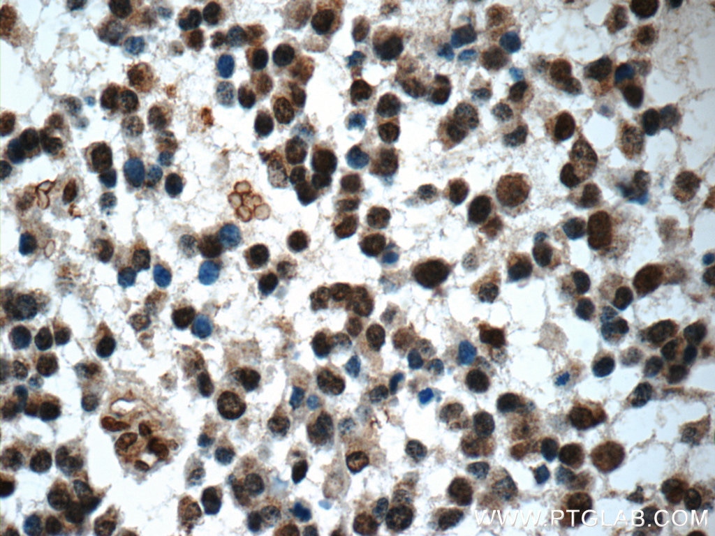 Immunohistochemistry (IHC) staining of human gliomas tissue using ZNF124 Polyclonal antibody (25216-1-AP)