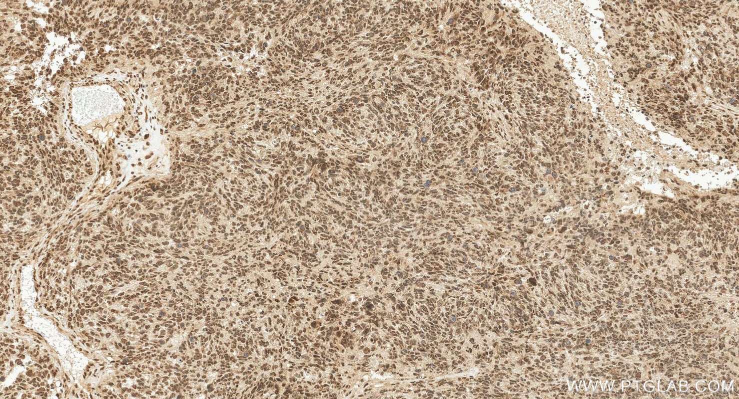 IHC staining of human gliomas using 25216-1-AP Immunohistochemistry (IHC) staining of human gliomas tissue using ZNF124 Polyclonal antibody (25216-1-AP)