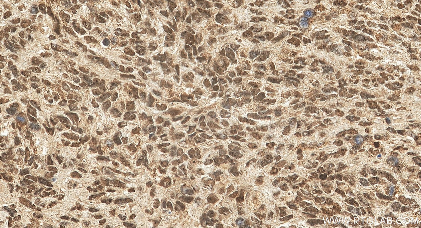 IHC staining of human gliomas using 25216-1-AP Immunohistochemistry (IHC) staining of human gliomas tissue using ZNF124 Polyclonal antibody (25216-1-AP)