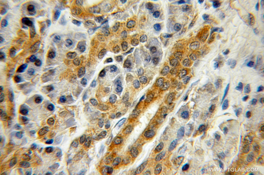 IHC staining of human pancreas cancer using 11282-1-AP