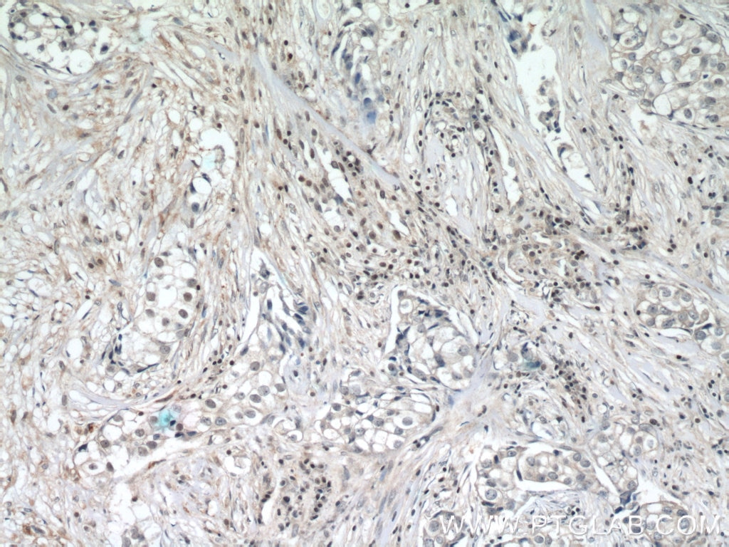 Immunohistochemistry (IHC) staining of human breast cancer tissue using ZNF24 Polyclonal antibody (11219-1-AP)