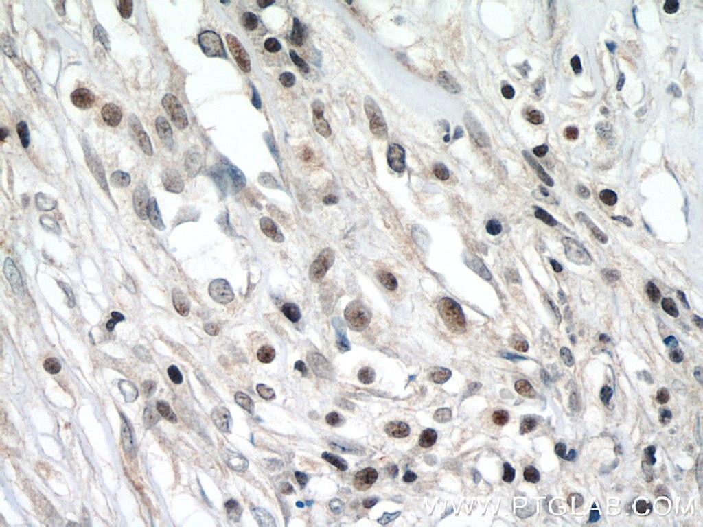 Immunohistochemistry (IHC) staining of human breast cancer tissue using ZNF24 Polyclonal antibody (11219-1-AP)