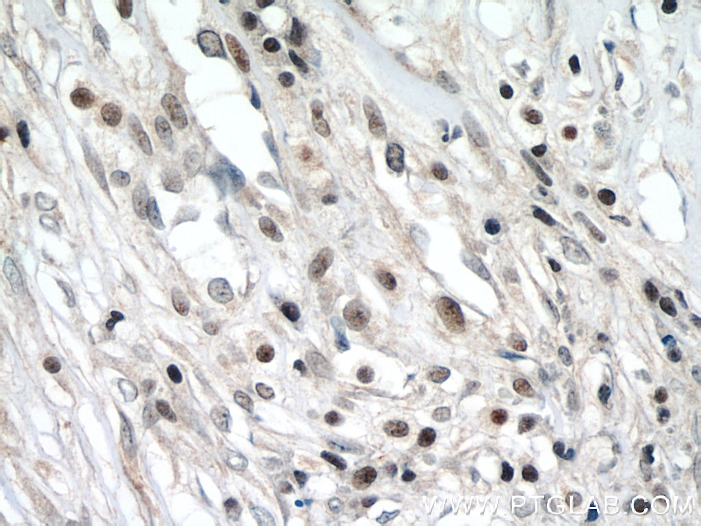 IHC staining of human breast cancer using 11219-1-AP