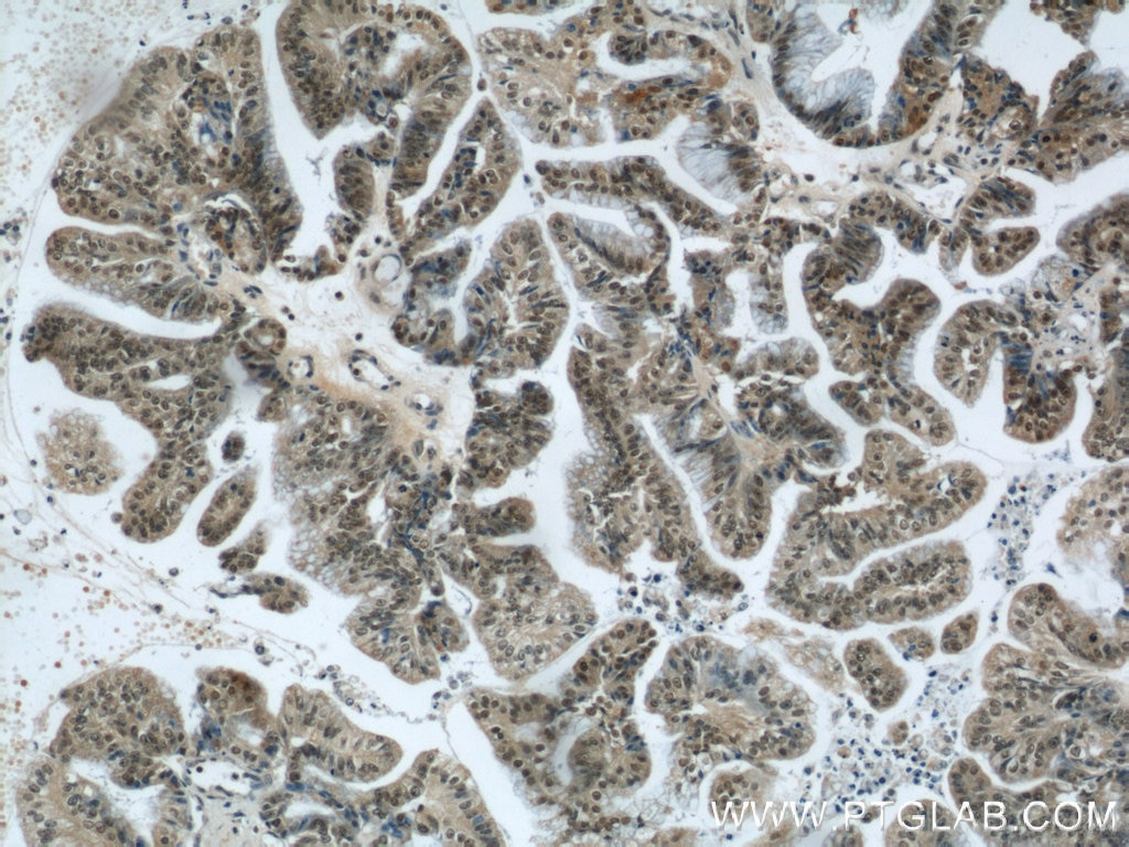 Immunohistochemistry (IHC) staining of human ovary tumor tissue using ZNF24 Polyclonal antibody (11219-1-AP)