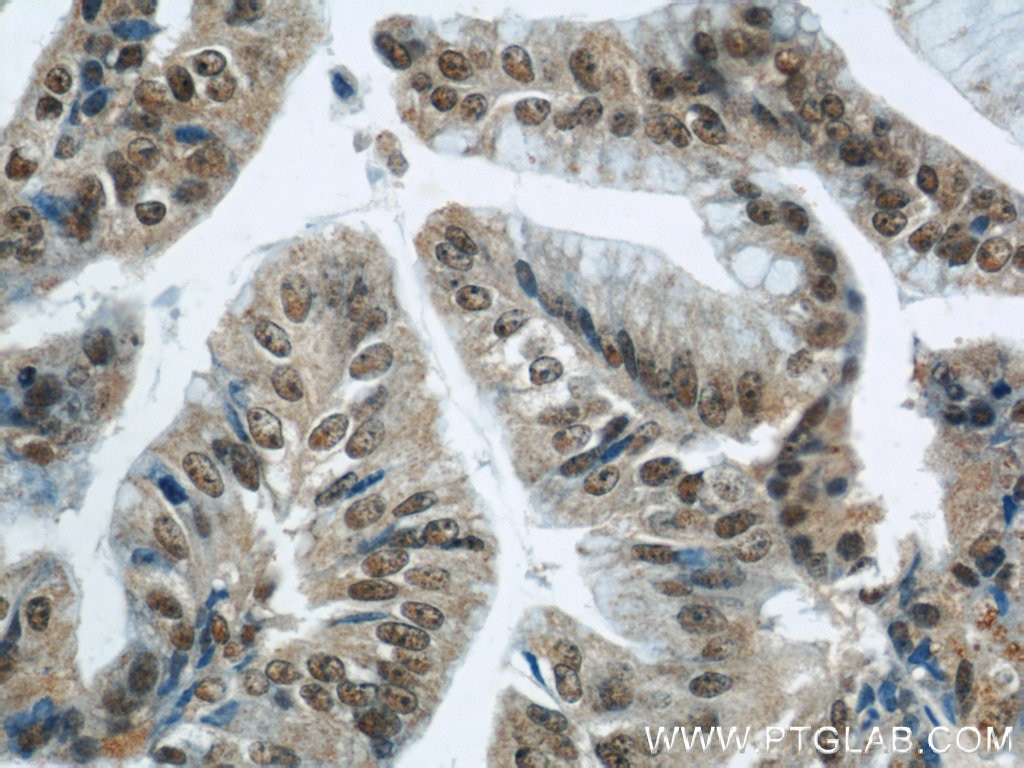 IHC staining of human ovary tumor using 11219-1-AP