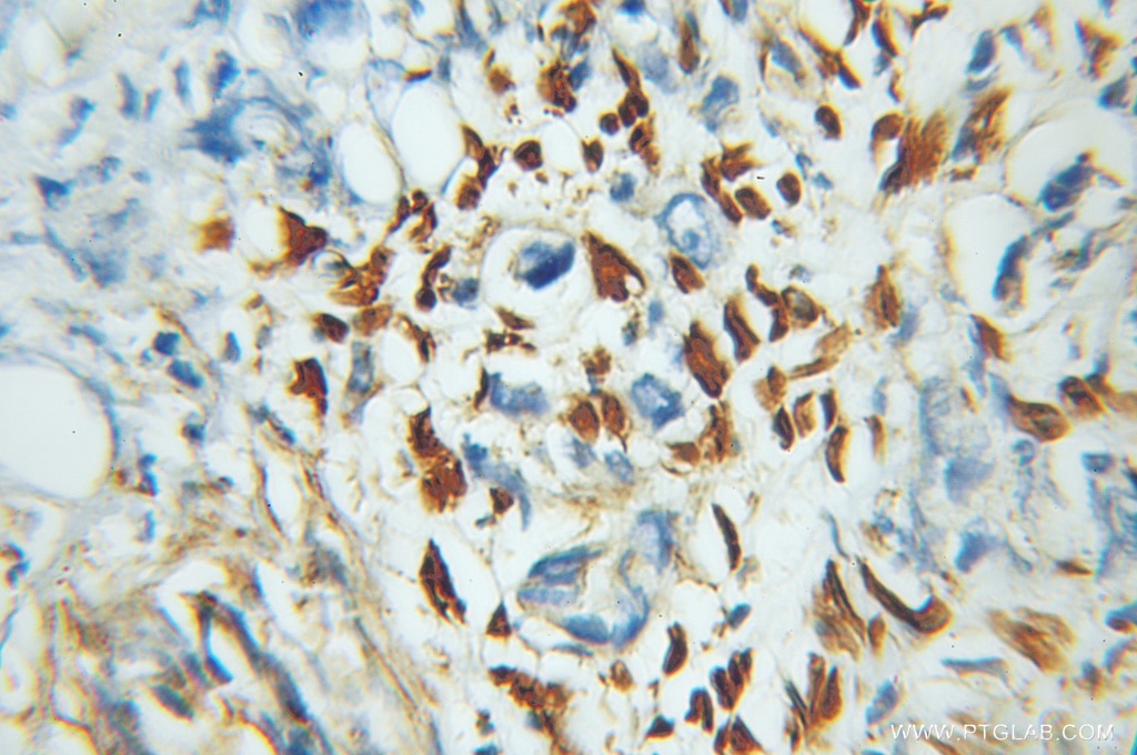 Immunohistochemistry (IHC) staining of human prostate cancer tissue using ZNF266 Polyclonal antibody (11374-1-AP)