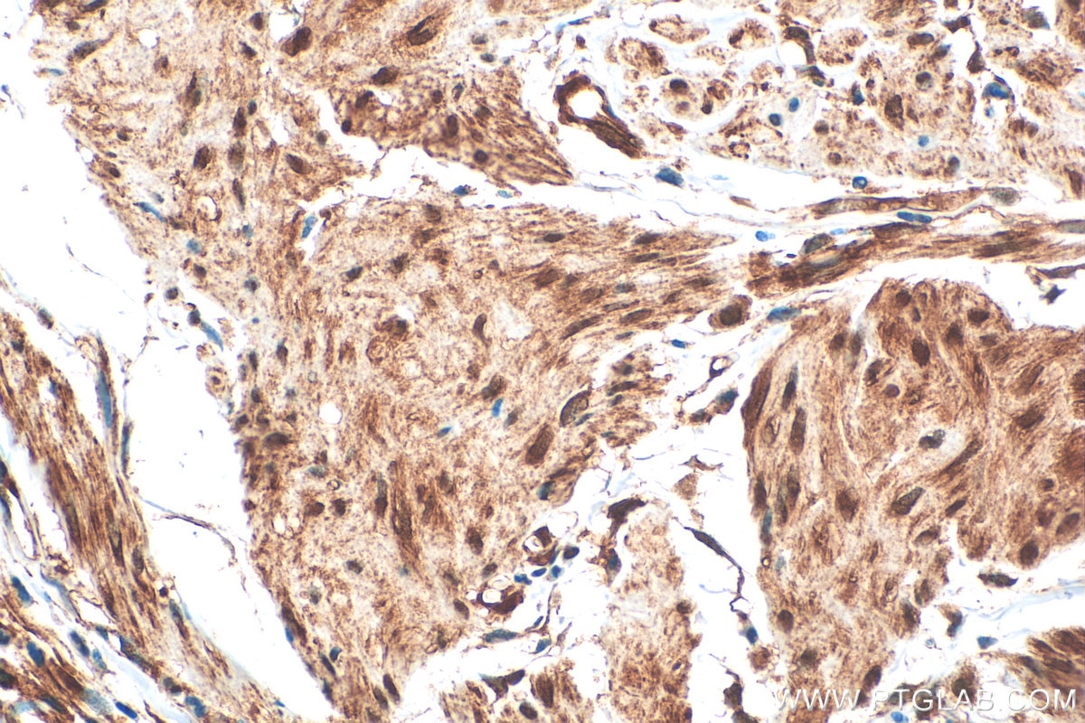 Immunohistochemistry (IHC) staining of human urothelial carcinoma tissue using ZNF394 Polyclonal antibody (25785-1-AP)